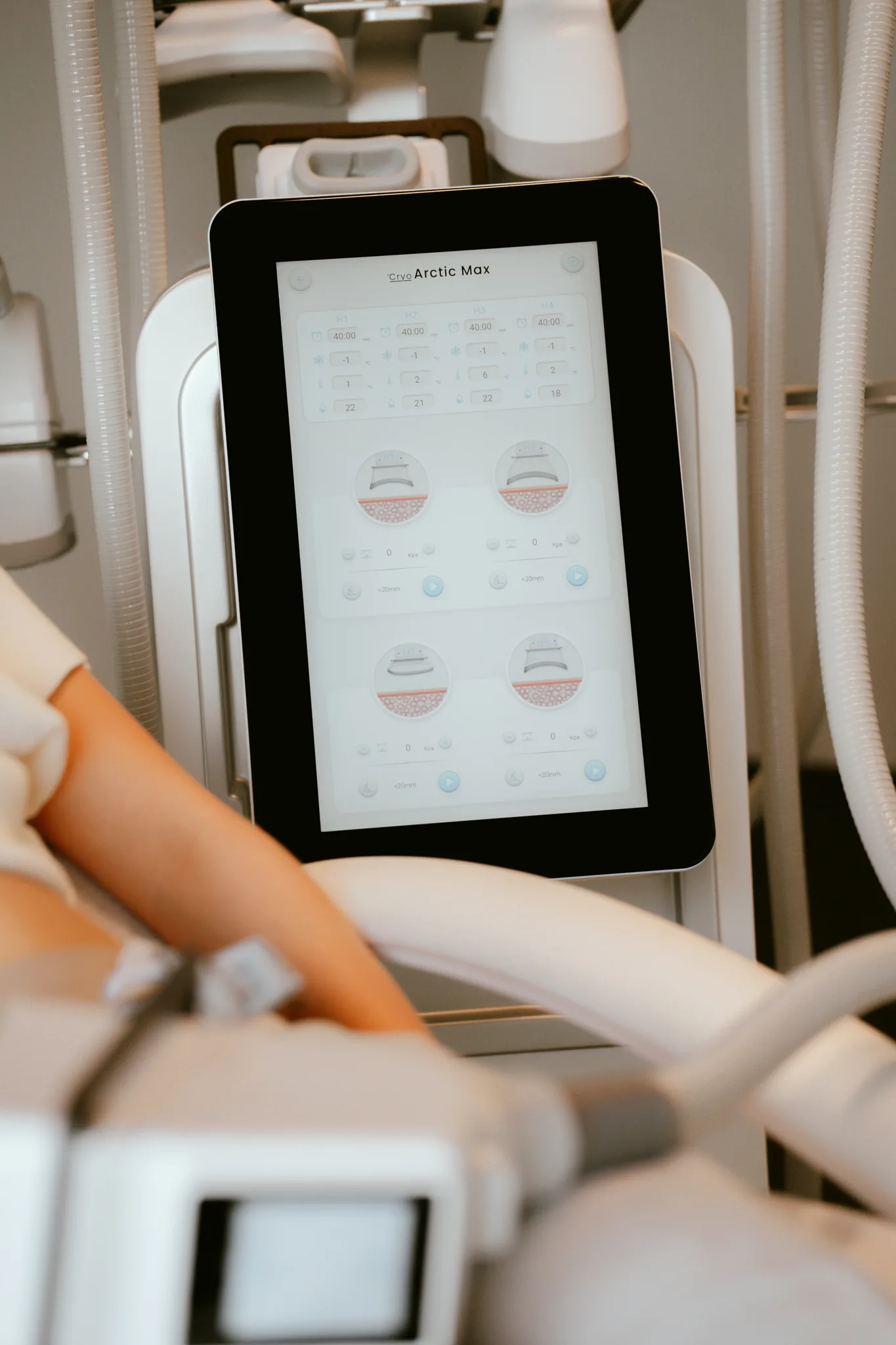 Cryo Arctic Max in actie tijdens een behandeling